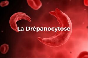 Drépanocytose 